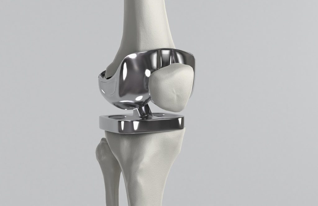 人工关节